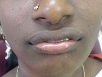 after dental treatment